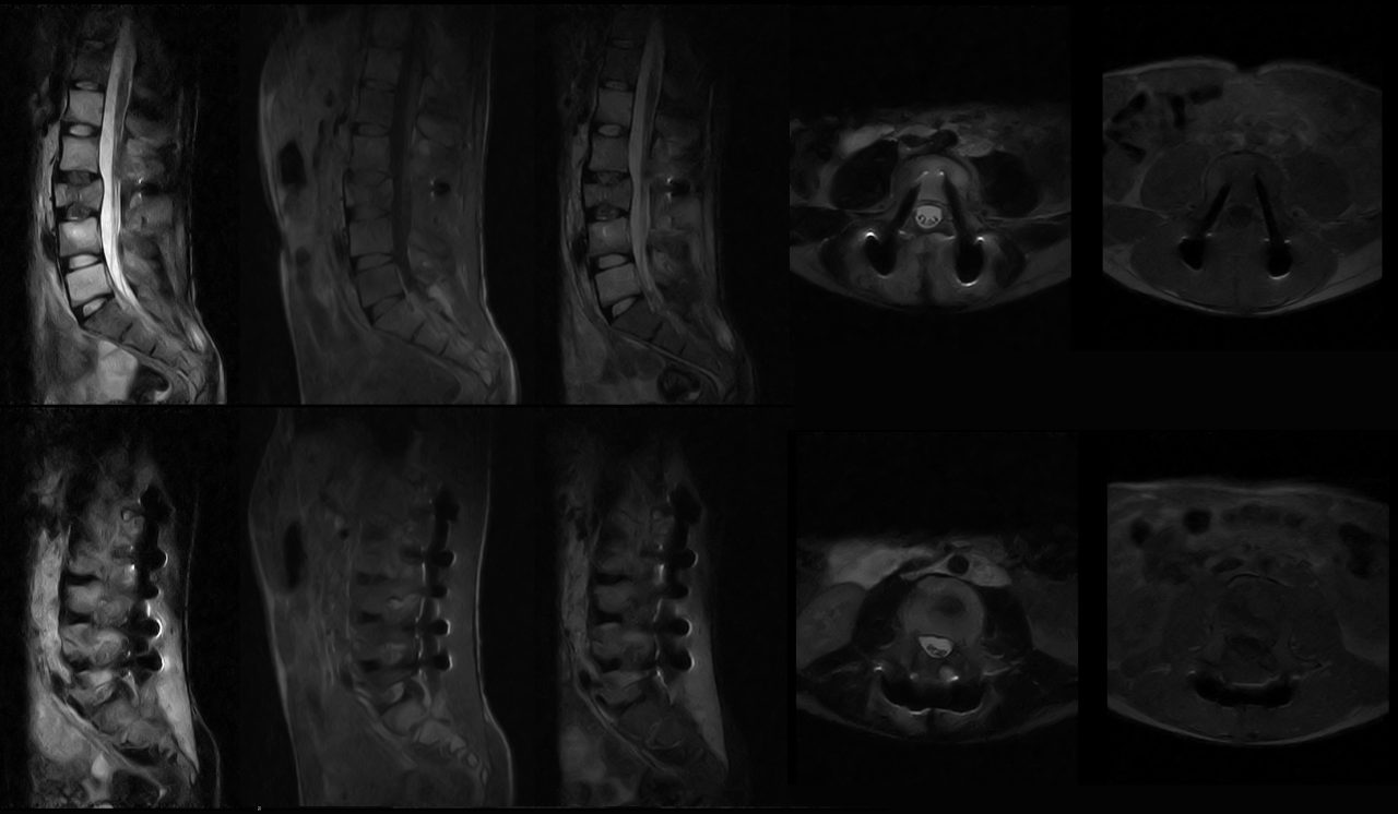 Ressonância magnética aberta com Implantes metálicos